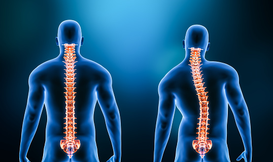 Comparison between normal backbone and scoliosis curvature of the spine with male model from back view 3D rendering illustration. Human anatomy, spinal disorders or deformity, backbone pathology, medical concepts.