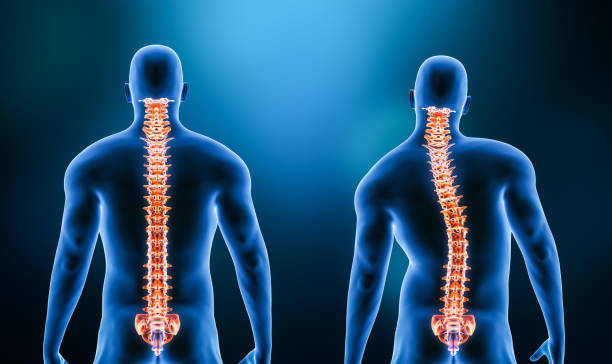 Comparison between normal backbone and scoliosis curvature of the spine with male model from back view 3D rendering illustration. Human anatomy, spinal disorders or deformity, backbone pathology, medical concepts. stock photo