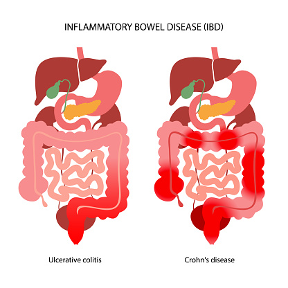 Inflammatory bowel disease concept. Crohns disease and ulcerative colitis. Inflammation of the digestive tract abdominal pain, colon problem in the human body. Medical poster flat vector illustration