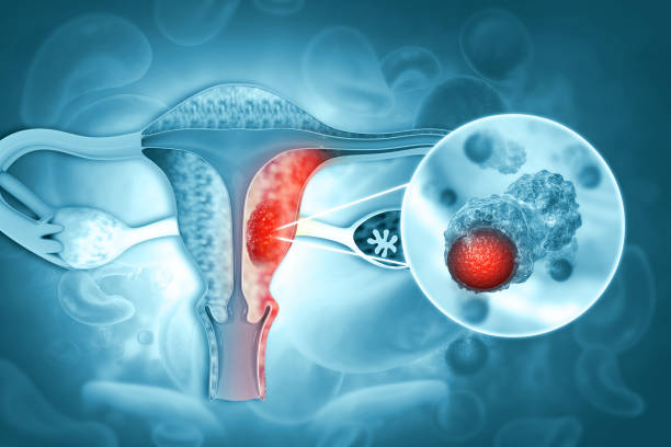 enfermedades del sistema reproductivo femenino.cáncer de útero y tumor maligno de endometrio como concepto médico uterino.3d ilustración - útero humano fotografías e imágenes de stock