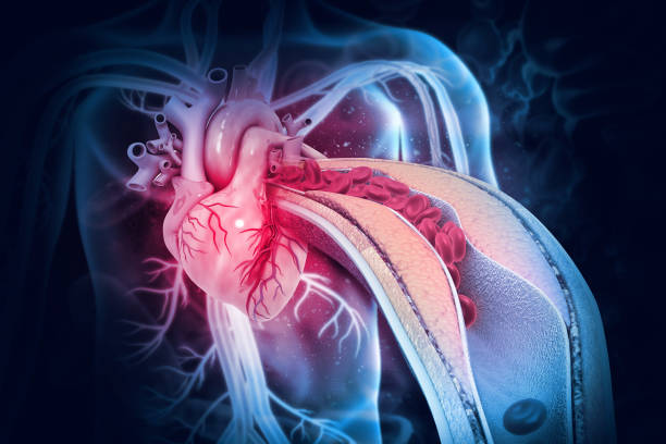 placca di colesterolo nell'arteria con anatomia del cuore umano. illustrazione 3d - arresto cardiaco foto e immagini stock