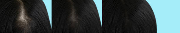 woman head baldness before and after treatment woman head baldness before and after treatment woman hairline stock pictures, royalty-free photos & images