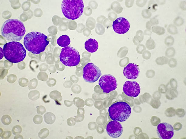 Chronic myeloid leukemia (CML). Red blood cell. Chronic myeloid leukemia (CML). Red blood cell. Blood smear microscopic 100x image. white blood cell stock pictures, royalty-free photos & images