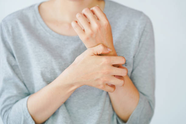 한 여성이 팔을 긁거나 알레르기 반응을 경험하거나 곤충에 찔려 있습니다. 피부 질환 개념. - 건선 뉴스 사진 이미지
