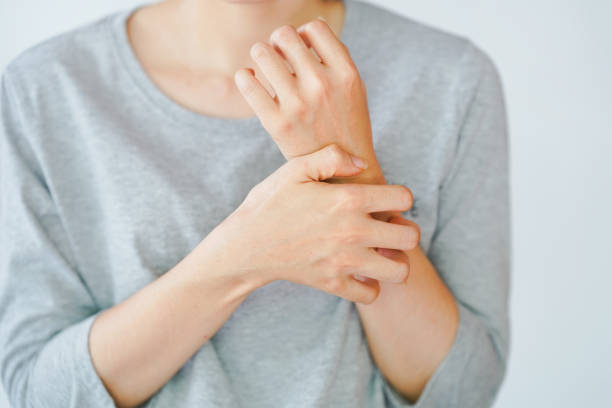 a woman scratching her arm, experiencing an allergic reaction or being stung by an insect. skin disease concept. - frieiras imagens e fotografias de stock