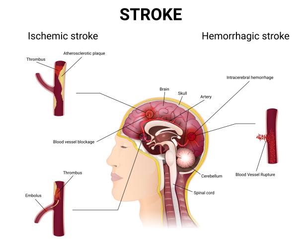 causes of stroke and the development of the disease brain in a section, arteries with a thrombus and atherosclerotic plaque, intracerebral bleeding, medical illustration of ischemic and hemorrhagic stroke cerebrum stock illustrations