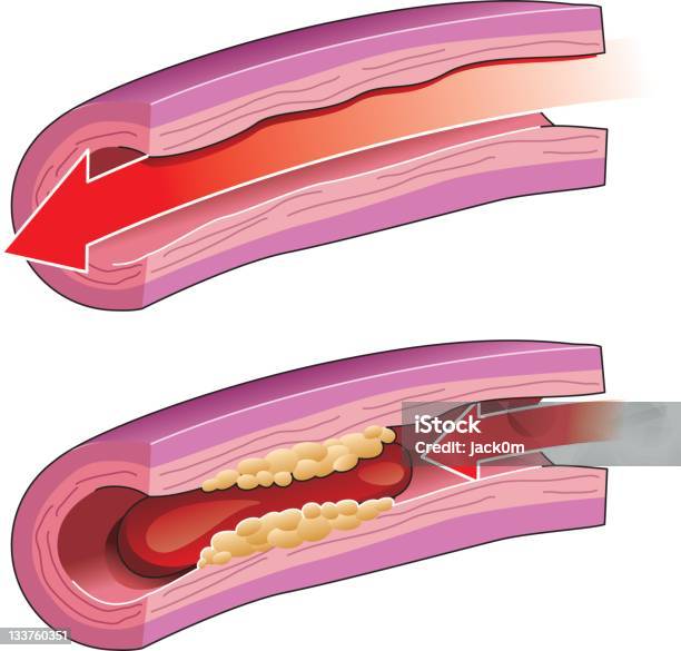 Zakrzepica - Stockowe grafiki wektorowe i więcej obrazów Tętnica - Tętnica, Miażdżyca tętnic, Niedrożność