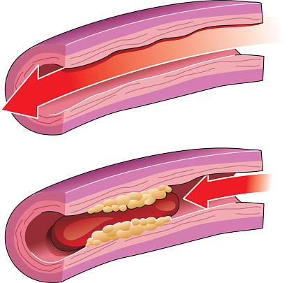 formation of a blood clot (thrombus), on top the blood flow free through artery, at the bottom the blood clot obstructing the flow of blood, vector file coloured with gradient and easy to change colour