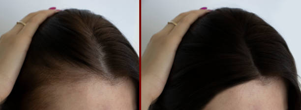 woman head baldness before and after treatment woman head baldness before and after treatment woman hairline stock pictures, royalty-free photos & images