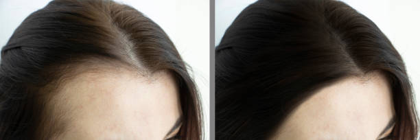 woman head baldness before and after treatment woman head baldness before and after treatment woman hairline stock pictures, royalty-free photos & images