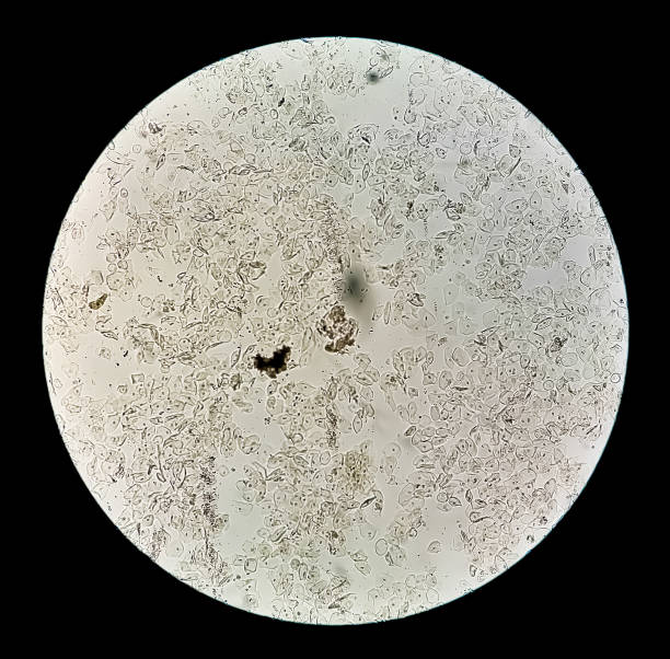 istock Microphotograph of Urine Analysis. Abnormal Urine sample analysis 1337678794