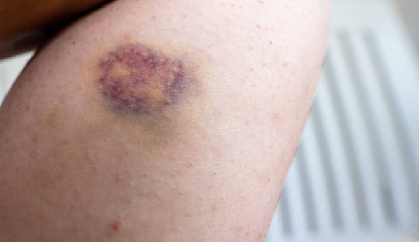 detail of bruise or a blood clot of a young woman leg final stage of bruising example on right leg of a female person for medicine health physical injury wounding accident healthcare victim body parts concepts bruise stock pictures, royalty-free photos & images