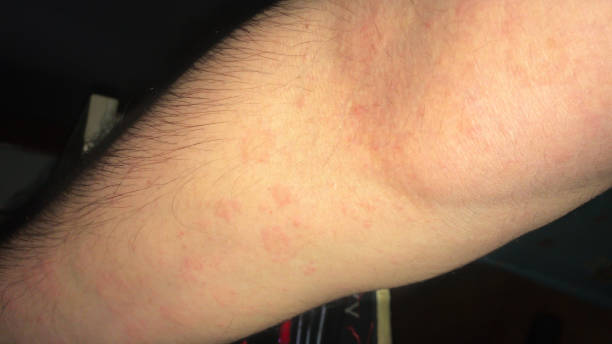 slight erythema multiforme rash on a person's arm detail of an arm of a male person with eczema rash for medicine medical allergic reactions health care symptoms cure concepts erythema nodosum stock pictures, royalty-free photos & images