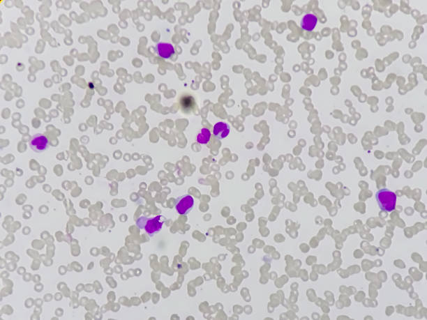 Acute myeloid leukemia (AML). Acute myeloid leukemia (AML). Red blood cell. Blood smear microscopic 100x image. acute angle stock pictures, royalty-free photos & images