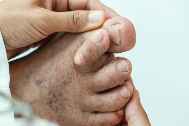 발가락 을 건너 - bunion bunions human foot podiatry 뉴스 사진 이미지