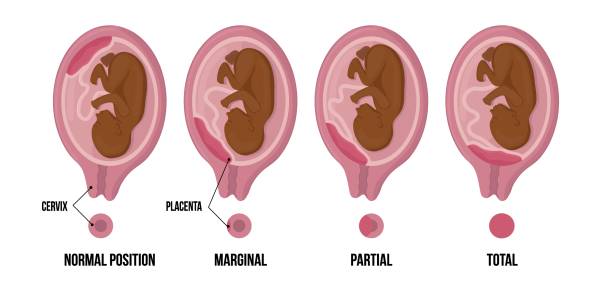 Different Placental Locations During African afroamerican Pregnancy. Normal, marginal, partial and total previa. black and brown skin. Different Placental Locations During African afroamerican Pregnancy. Normal, marginal, partial and total previa. black and brown skin. medical vector illustration. placenta closes the cervical canal placenta stock illustrations