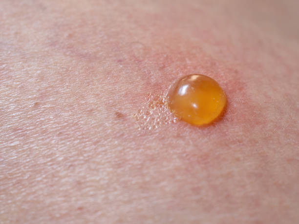 istock Insect bite on skin with blister. 1337884143