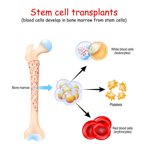 Stem cell transplants Stem cell transplants. blood cells develop in bone marrow from stem cells. erythrocytes, leukocytes and Platelets stem cell illustrations stock illustrations
