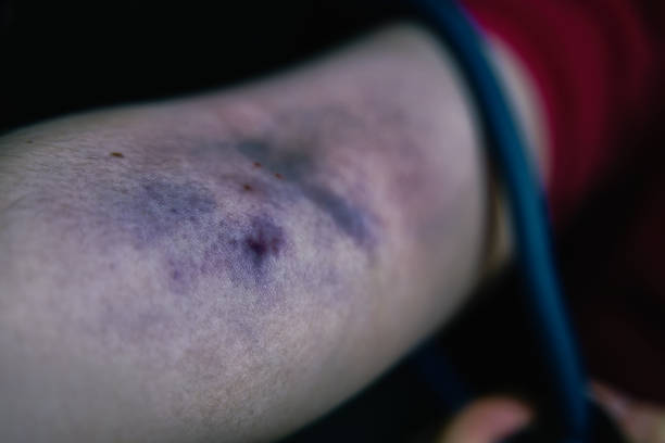 stichwunden und prellungen am arm der frau. - iv bruise stock-fotos und bilder