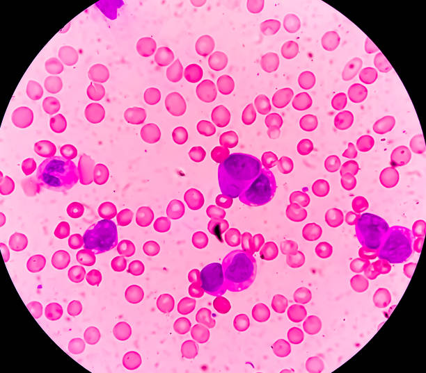 фотомикрограф острого миелобластного лейкоза (омл), рака лейкоцитов - cancer cell flash стоковые фото и изображения