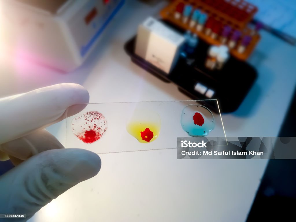 Blood grouping on glass slide showing AB+ group. Blood group testing by slide agglutination method. Blood Group Stock Photo