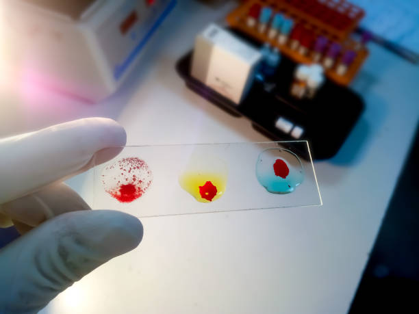 Blood grouping on glass slide showing AB+ group. Blood group testing by slide agglutination method. stock photo