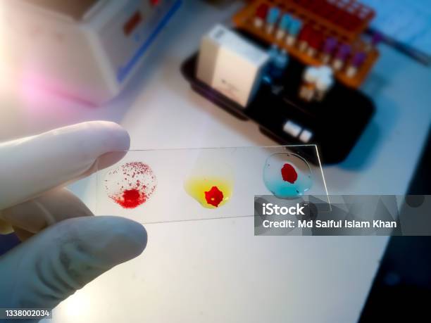 Blood Grouping On Glass Slide Showing Ab Group Blood Group Testing By Slide Agglutination Method Stock Photo - Download Image Now