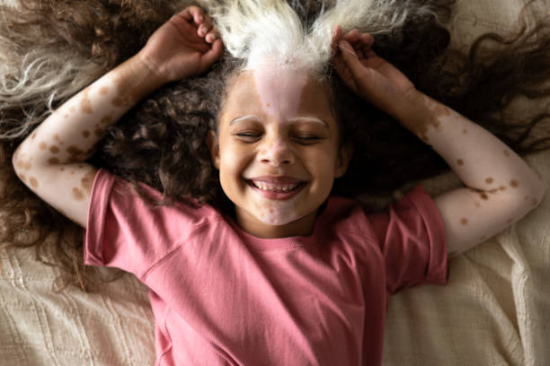 Girl with piebaldism lying down on the bed at home