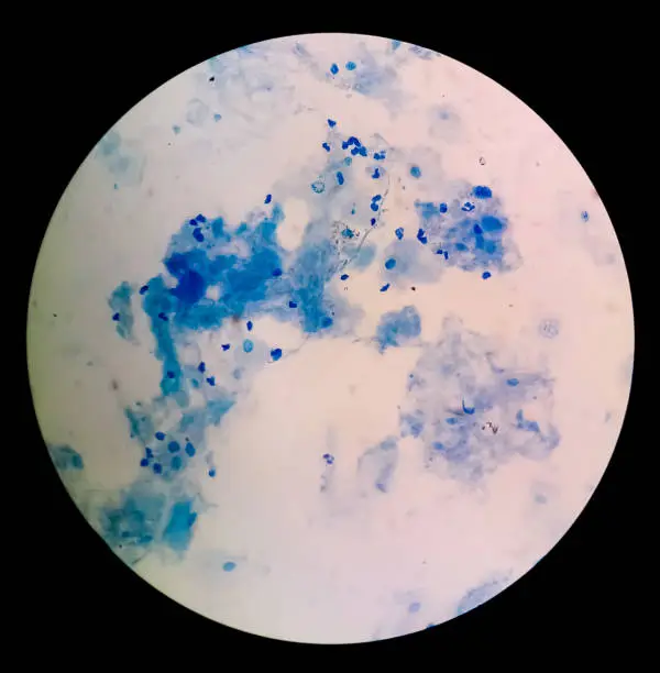 Photo of Sputum smear under microscopy showing gram positive cocci bacteria. Smear of Gram's stained from sputum specimen