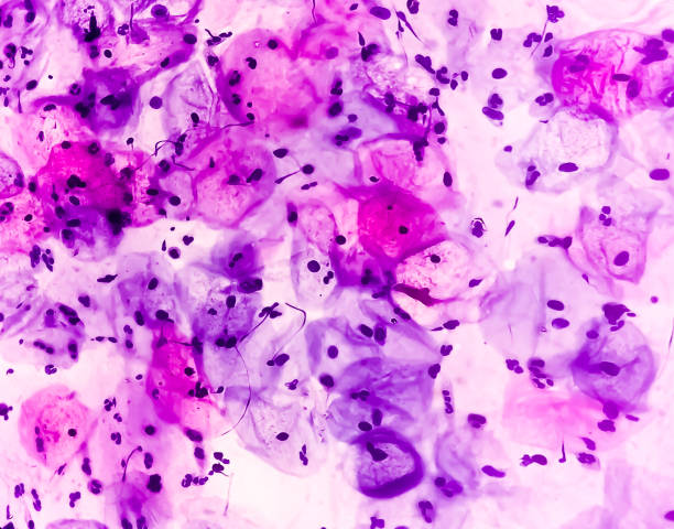 Microscopic view of human cervix cells. Squamous epithelial cells. Pap smear. pap's. Squamous cell carcinoma (SCC) Microscopic view of human cervix cells. Squamous epithelial cells. Pap smear. pap's. Squamous cell carcinoma (SCC) adenocarcinoma photos stock pictures, royalty-free photos & images