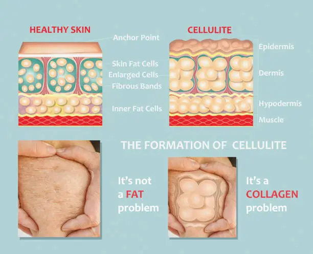 Forming of underskin cellulite illustration. Structure of normal healthy and cellulite skin. Comparison