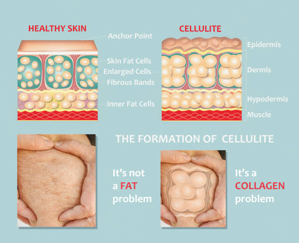 forming of underskin cellulite illustration - fat layer imagens e fotografias de stock