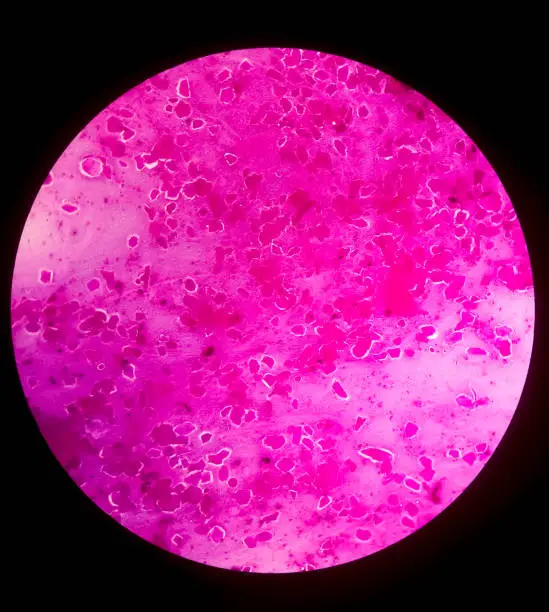 Photo of Sputum smear under microscopy showing gram positive cocci bacteria. Smear of Gram's stained from sputum specimen