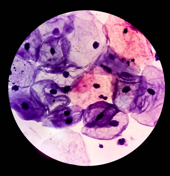 Microscopic view of Paps smear, 100x. Medical or health concept. cytology or histology Microscopic view of Paps smear, 100x. Medical or health concept. cytology or histology squamous cell carcinoma photos stock pictures, royalty-free photos & images