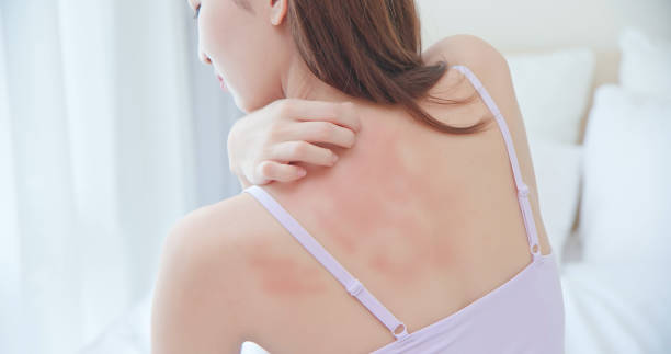 woman scratching her back - 濕疹 個照片及圖片檔