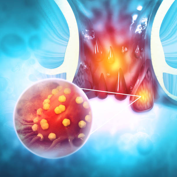hemorroides (pilas) o cáncer de colon en antecedentes científicos. ilustración 3d - estreñimiento fotografías e imágenes de stock