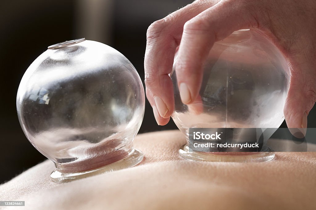 Cupping therapy Chinese traditional medicine, cupping therapy Vacuum Cupping Stock Photo