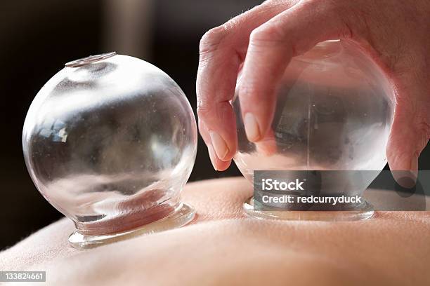 Cupping Therapy Stock Photo - Download Image Now - Vacuum Cupping, Chinese Herbal Medicine, Healthcare And Medicine