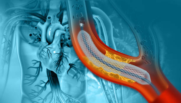 stent-angioplastie auf wissenschaftlichem hintergrund. 3d-illustration - angioplasty stock-fotos und bilder