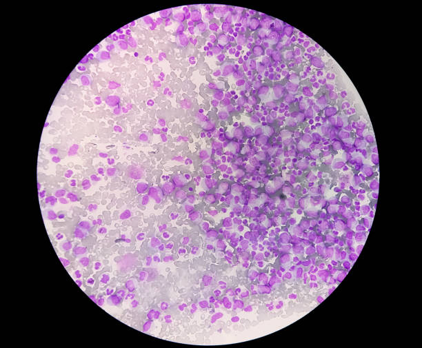 микроскопический вид тромбоцитопении при лейкоцитозе. гематология, 40х - cancer cell flash стоковые фото и изображения