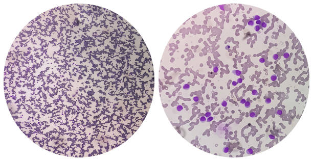 istock Collage image of two micrograph show Auer rods seen in acute myeloid leukemia. Myeloblasts 1338259854