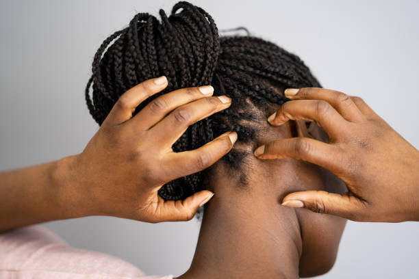 Itching Dry Head Scalp And Long Hair Itching Dry Head Scalp And Long Hair With Dandruff dandruff stock pictures, royalty-free photos & images