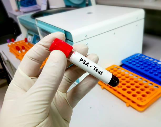 Blood sample in tube labeled with text PSA test. Closeup. Doctor or Scientist holding tube for Prostate Specific Antigen test. Laboratory Background. stock photo