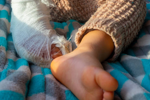 enfant avec bandage sur fracture du talon de la jambe. pied droit cassé, attelle du tout-petit. petit garçon endormi sur une couverture bleue - physical injury bandage wound cast photos et images de collection