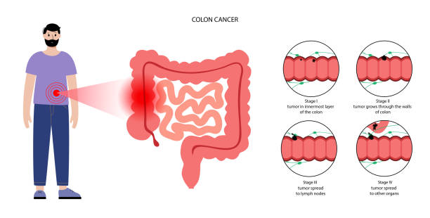 Colon cancer stage Colorectal cancer concept. Development of cancer from the colon or rectum to the whole large intestine. Stages of spreading tumor to the lymph nodes and other internal organs vector flat illustration. colon cancer screening stock illustrations