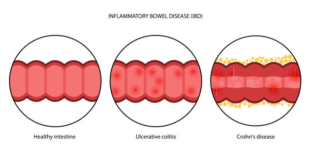 Ibd Types Infographic 40+ Ibd Infographic Stock Illustrations, Royalty-Free Vector Graphics ...
