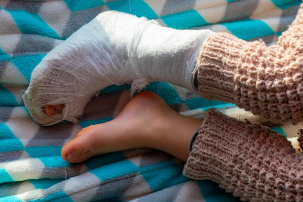 enfant avec bandage sur fracture du talon de la jambe. pied droit cassé, attelle du tout-petit. petit garçon endormi sur une couverture bleue - physical injury bandage wound cast photos et images de collection