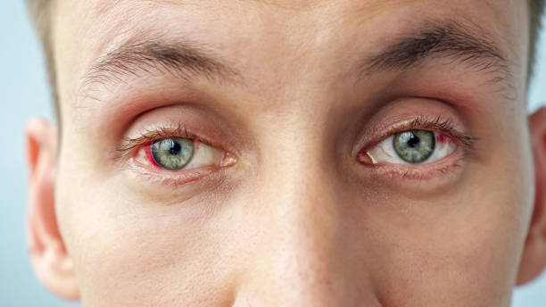 istock young man with red eyes looking at the camera 1338647540