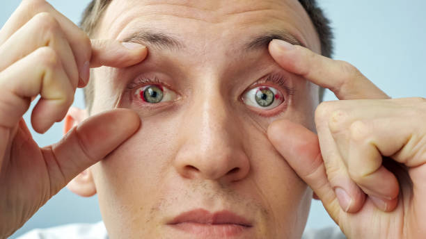 istock man with red eyes raising eyelids with fingers looking at the camera 1338647545