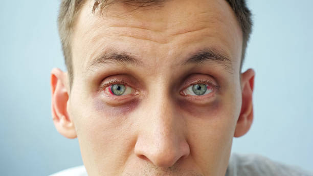 istock young man with red eyes looking at the camera 1338647546